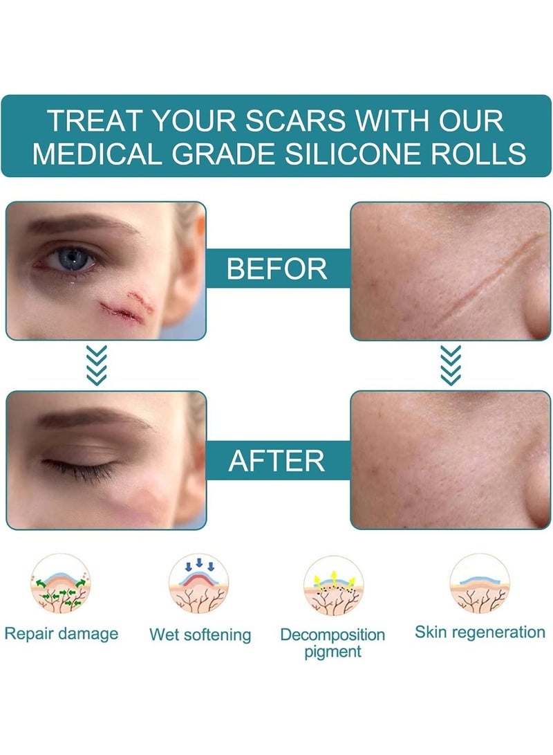 Walpck Medical Grade Silicone Scar Sheets, Silicone Scar Tape (4cm*1.5m), Scar Removal Strips for Acne Scars C-Section & Keloid Surgery Scars Sheets Treatment Sheets - 6-8 Month Supply - Image 5